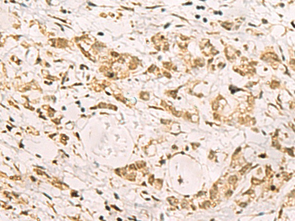 Immunohistochemistry of paraffin-embedded Human gastric cancer tissue  using PDS5A Polyclonal Antibody at dilution of 1:90(?200)