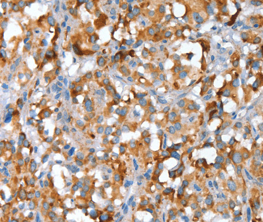 Immunohistochemistry of paraffin-embedded Human thyroid cancer using SNAI1 Polyclonal Antibody at dilution of 1:30