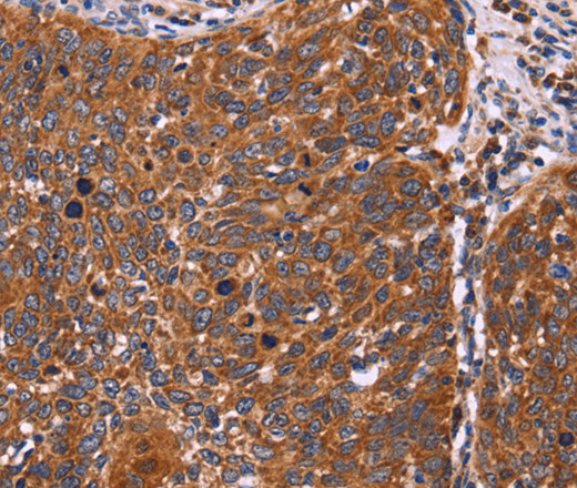 Immunohistochemistry of paraffin-embedded Human cervical cancer tissue using FBXW7 Polyclonal Antibody at dilution 1:40