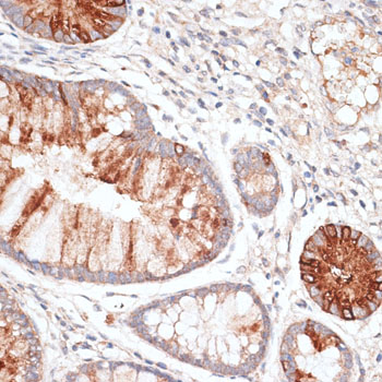 Immunohistochemistry of paraffin-embedded human colon carcinoma using KIR3DL3 Polyclonal Antibody at dilution of 1:100 (40x lens).Perform microwave antigen retrieval with 10 mM PBS buffer pH 7.2 before commencing with IHC staining protocol.