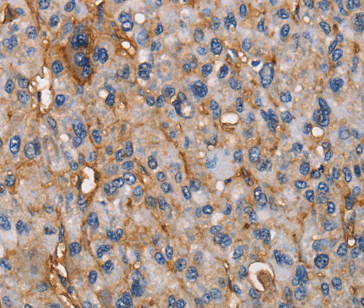 Immunohistochemistry of paraffin-embedded Human liver cancer tissue using CD73 Polyclonal Antibody at dilution 1:50