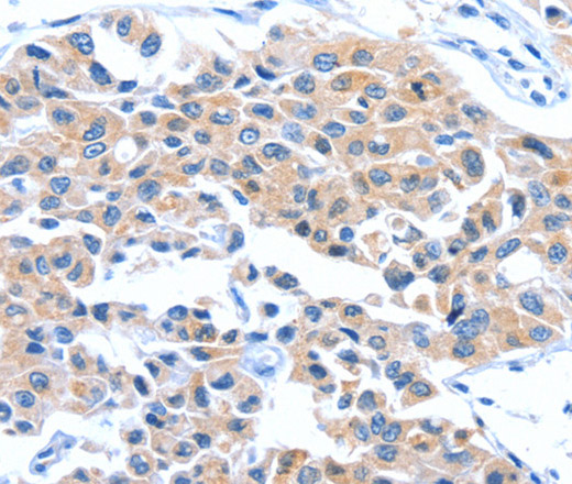 Immunohistochemistry of paraffin-embedded Human lung cancer tissue using ARL11 Polyclonal Antibody at dilution 1:50