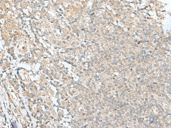 Immunohistochemistry of paraffin-embedded Human tonsil tissue  using SLC26A3 Polyclonal Antibody at dilution of 1:35(?200)