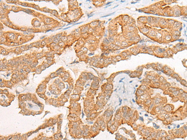 Immunohistochemistry of paraffin-embedded Human thyroid cancer tissue  using CYB5D1 Polyclonal Antibody at dilution of 1:45(?200)