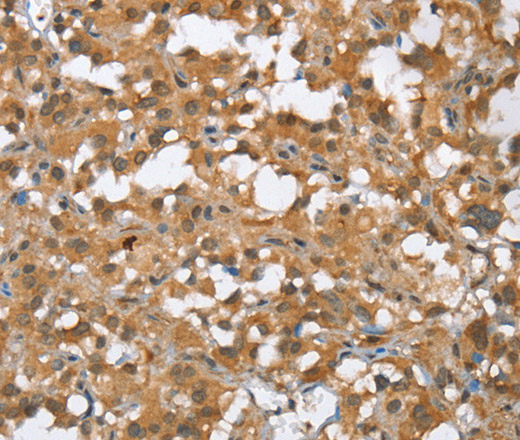 Immunohistochemistry of paraffin-embedded Human thyroid cancer tissue using MMP12 Polyclonal Antibody at dilution of 1:60