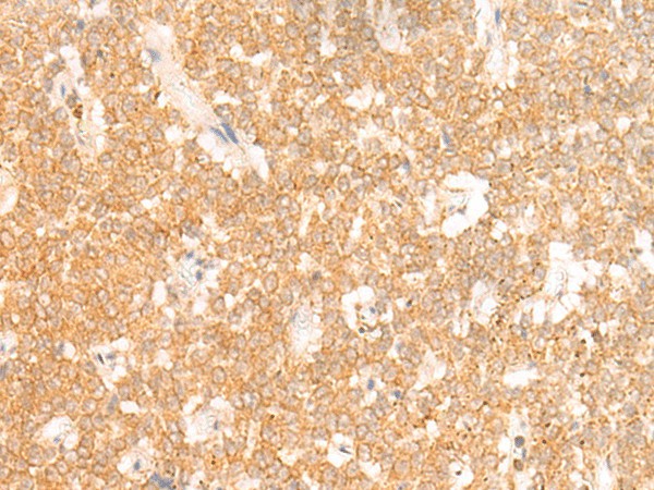 Immunohistochemistry of paraffin-embedded Human ovarian cancer tissue  using RRP8 Polyclonal Antibody at dilution of 1:50(?200)