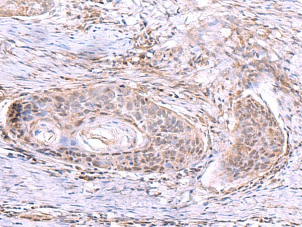 Immunohistochemistry of paraffin-embedded Human esophagus cancer tissue  using AKAP17A Polyclonal Antibody at dilution of 1:80(?200)