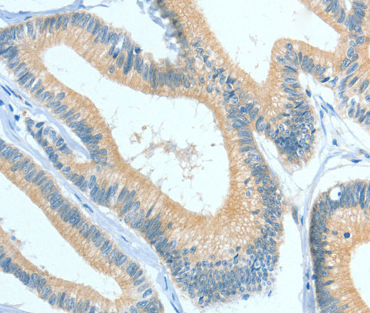 Immunohistochemistry of paraffin-embedded Human colon cancer using ASGR1 Polyclonal Antibody at dilution of 1:50