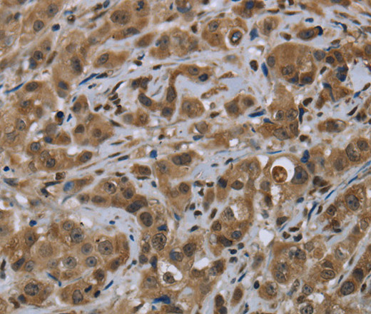 Immunohistochemistry of paraffin-embedded Human breast cancer using FTO Polyclonal Antibody at dilution of 1:60