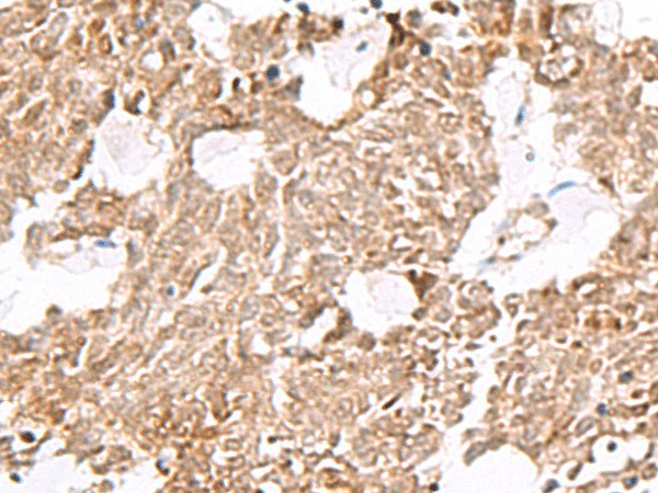 Immunohistochemistry of paraffin-embedded Human lung cancer tissue  using ELF3 Polyclonal Antibody at dilution of 1:60(?200)