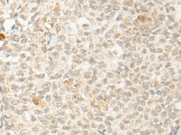 Immunohistochemistry of paraffin-embedded Human ovarian cancer tissue  using OTX1 Polyclonal Antibody at dilution of 1:30(?200)