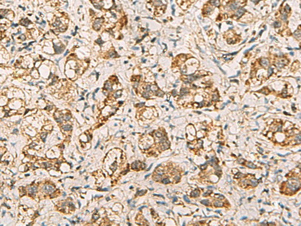 Immunohistochemistry of paraffin-embedded Human liver cancer tissue  using VTA1 Polyclonal Antibody at dilution of 1:60(?200)