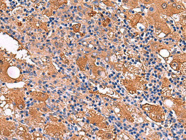 Immunohistochemistry of paraffin-embedded Human liver cancer tissue  using FUCA2 Polyclonal Antibody at dilution of 1:80(?200)