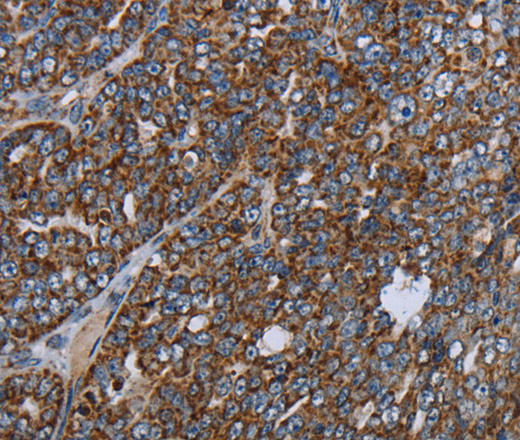 Immunohistochemistry of paraffin-embedded Human ovarian cancer using NDUFA13 Polyclonal Antibody at dilution of 1:40