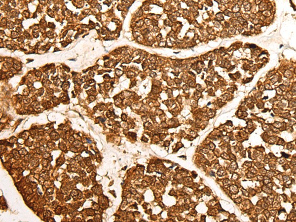 Immunohistochemistry of paraffin-embedded Human esophagus cancer tissue  using CALML6 Polyclonal Antibody at dilution of 1:55(?200)