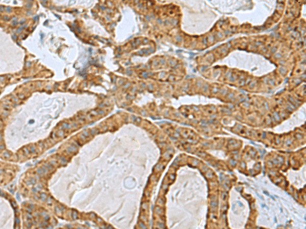 Immunohistochemistry of paraffin-embedded Human thyroid cancer tissue  using RPL10A Polyclonal Antibody at dilution of 1:50(?200)