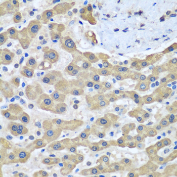 Immunohistochemistry of paraffin-embedded human liver cancer using GFM1 Polyclonal Antibody at dilution of 1:100 (40x lens).Perform microwave antigen retrieval with 10 mM PBS buffer pH 7.2 before commencing with IHC staining protocol.