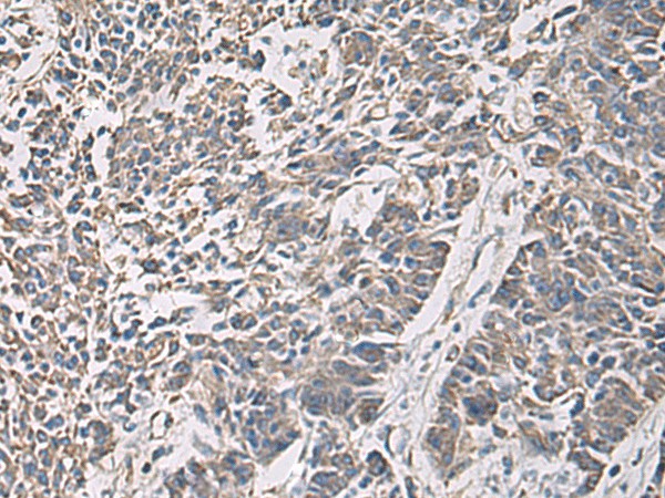 Immunohistochemistry of paraffin-embedded Human colorectal cancer tissue  using PRKCSH Polyclonal Antibody at dilution of 1:90(?200)