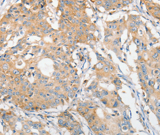 Immunohistochemistry of paraffin-embedded Human gastric cancer using APOBEC3G Polyclonal Antibody at dilution of 1:30