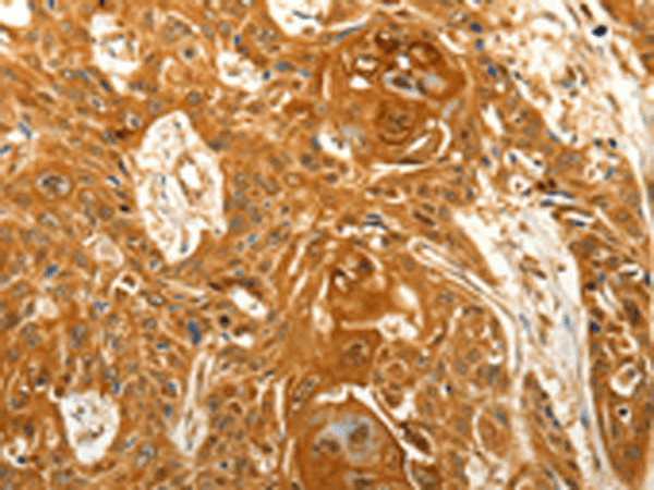 Immunohistochemistry of paraffin-embedded Human esophagus cancer tissue  using VSNL1 Polyclonal Antibody at dilution of 1:25(?200)