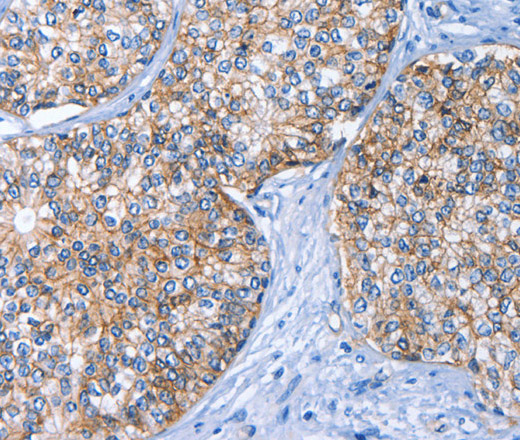 Immunohistochemistry of paraffin-embedded Human prostate cancer using CD239 Polyclonal Antibody at dilution of 1:40