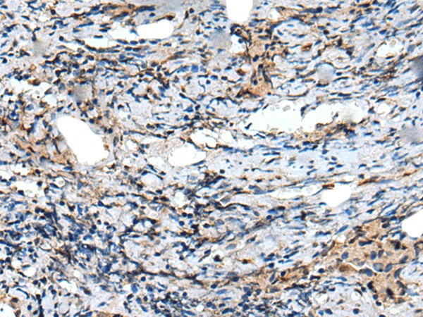 Immunohistochemistry of paraffin-embedded Human prost ate cancer tissue  using CXCL6 Polyclonal Antibody at dilution of 1:60(?200)