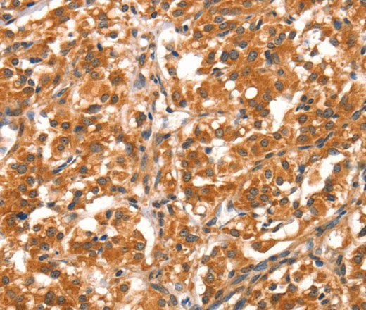 Immunohistochemistry of paraffin-embedded Human thyroid cancer tissue using DAB2IP Polyclonal Antibody at dilution 1:40