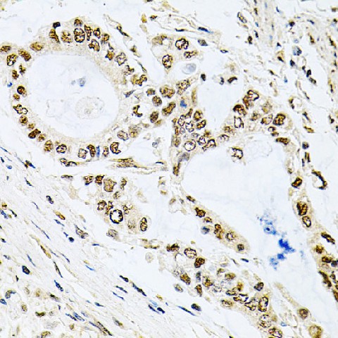 Immunohistochemistry of paraffin-embedded Human gastric cancer using MCL1 Polyclonal Antibody at dilution of  1:100 (40x lens).