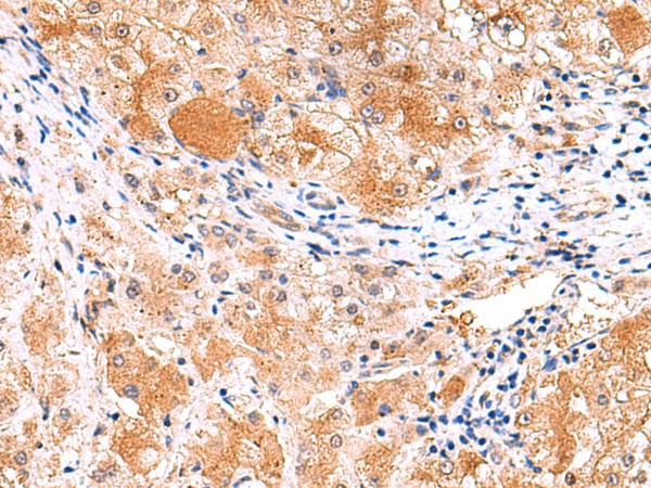 Immunohistochemistry of paraffin-embedded Human liver cancer tissue  using ITSN2 Polyclonal Antibody at dilution of 1:40(?200)