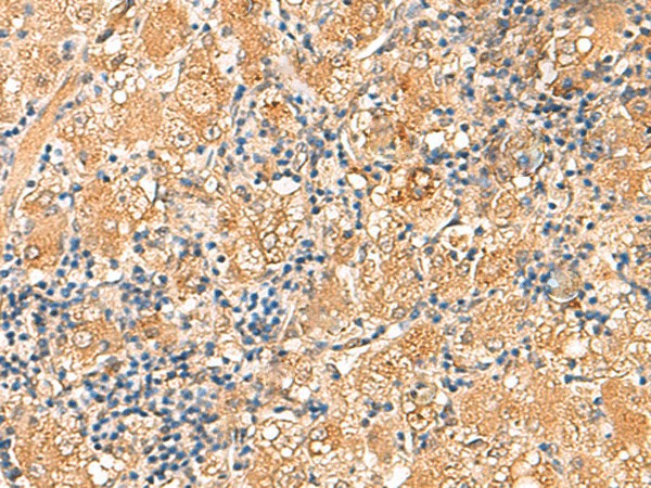 Immunohistochemistry of paraffin-embedded Human liver cancer tissue  using RPL13A Polyclonal Antibody at dilution of 1:60(?200)