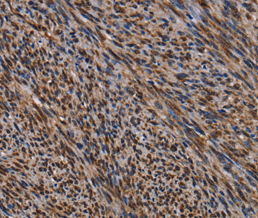 Immunohistochemistry of paraffin-embedded Human sarcoma tissue using KIF1C Polyclonal Antibody at dilution 1:60