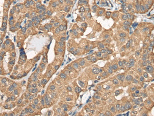 Immunohistochemistry of paraffin-embedded Human thyroid cancer tissue  using BCHE Polyclonal Antibody at dilution of 1:40(?200)