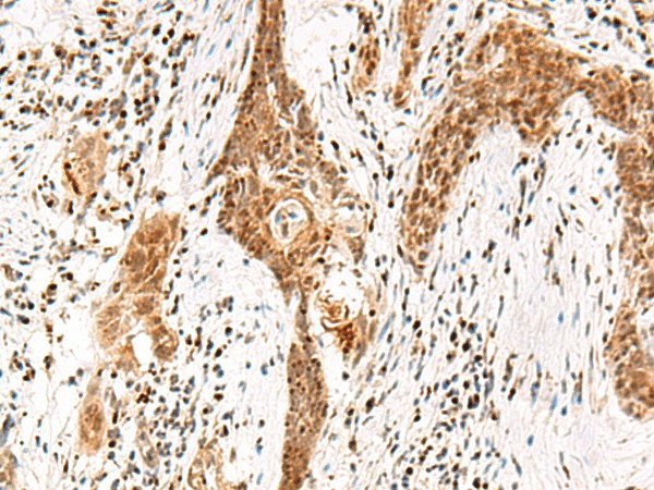 Immunohistochemistry of paraffin-embedded Human esophagus cancer tissue  using DGCR6L Polyclonal Antibody at dilution of 1:65(?200)