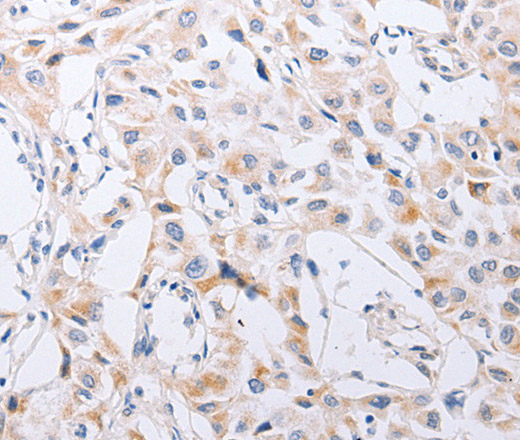 Immunohistochemistry of paraffin-embedded Human lung cancer tissue using SERP1 Polyclonal Antibody at dilution 1:30