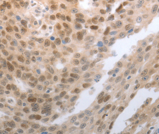 Immunohistochemistry of paraffin-embedded Human esophagus cancer tissue using SLC22A8 Polyclonal Antibody at dilution 1:70