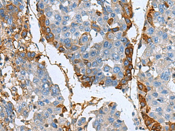 Immunohistochemistry of paraffin-embedded Human liver cancer tissue  using TGFBI Polyclonal Antibody at dilution of 1:60(?200)