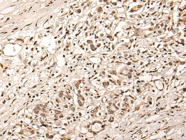 Immunohistochemistry of paraffin-embedded Human gastric cancer tissue  using ZSCAN12 Polyclonal Antibody at dilution of 1:40(?200)