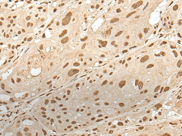 Immunohistochemistry of paraffin-embedded Human esophagus cancer tissue  using ZNF274 Polyclonal Antibody at dilution of 1:35(?200)