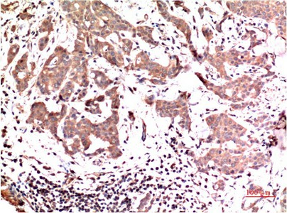 Immunohistochemistry of paraffin-embedded Human breast carcinoma tissue using ERK 1 Monoclonal Antibody at dilution of 1:200.