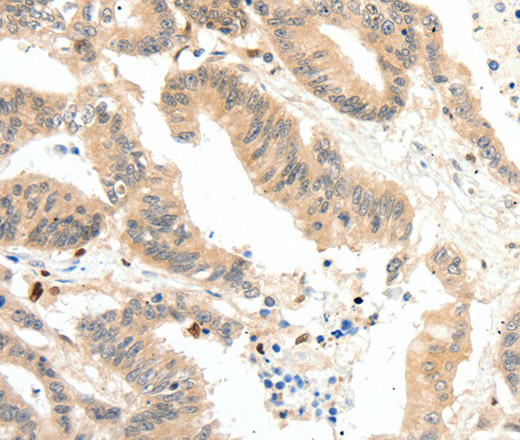 Immunohistochemistry of paraffin-embedded Human colon cancer tissue using RRAD Polyclonal Antibody at dilution 1:50