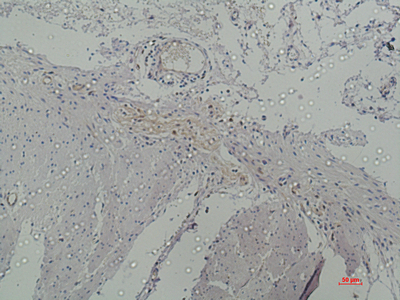 Immunohistochemistry of paraffin-embedded Human colon using Galectin 3 Monoclonal Antibody at dilution of 1:50.