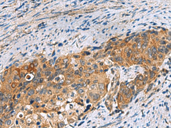 Immunohistochemistry of paraffin-embedded Human cervical cancer tissue  using JOSD1 Polyclonal Antibody at dilution of 1:70(?200)