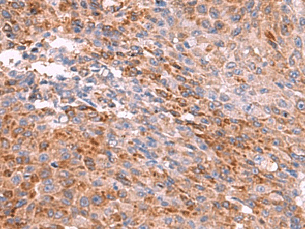 Immunohistochemistry of paraffin-embedded Human colorectal cancer tissue  using PEMT Polyclonal Antibody at dilution of 1:55(?200)