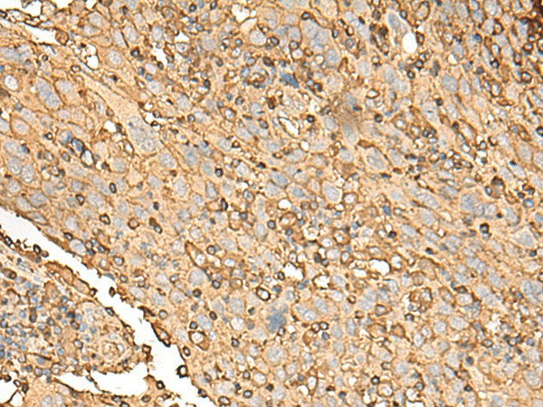 Immunohistochemistry of paraffin-embedded Human cervical cancer tissue  using UBE2A Polyclonal Antibody at dilution of 1:45(?200)