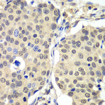 Immunohistochemistry of paraffin-embedded human lung cancer using Cyclin C Polyclonal antibody at dilution of 1:100 (40x lens).Perform microwave antigen retrieval with 10 mM PBS buffer pH 7.2 before commencing with IHC staining protocol.