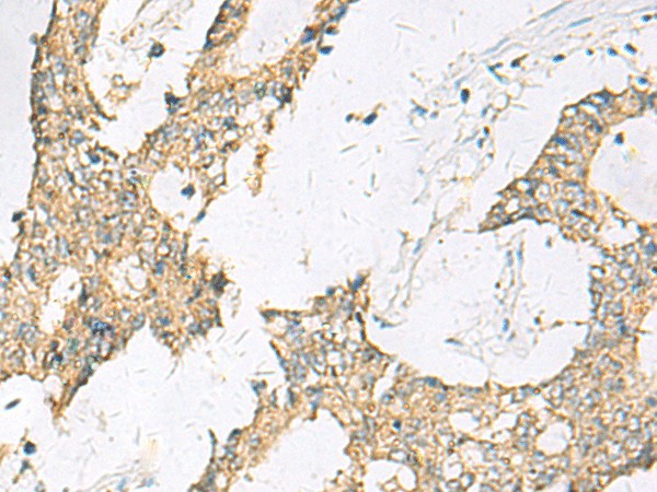 Immunohistochemistry of paraffin-embedded Human colorectal cancer tissue  using SPACA1 Polyclonal Antibody at dilution of 1:50(?200)