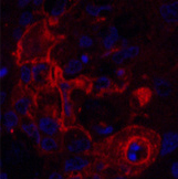 Immunofluorescence analysis of Human lung cancer tissue using CD66e Monoclonal Antibody at dilution of 1:200.