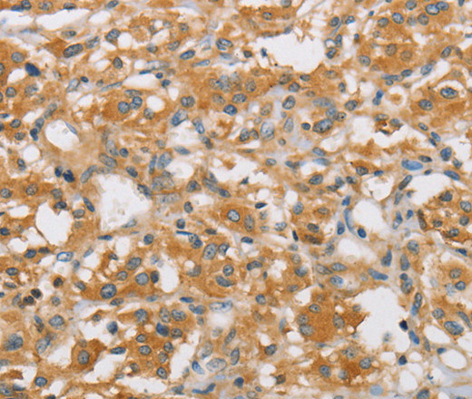 Immunohistochemistry of paraffin-embedded Human thyroid cancer using ARHGEF7 Polyclonal Antibody at dilution of 1:40