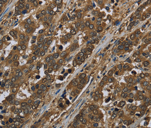 Immunohistochemistry of paraffin-embedded Human liver cancer tissue using SNCG Polyclonal Antibody at dilution 1:50