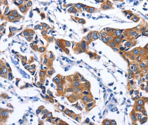 Immunohistochemistry of paraffin-embedded Human breast cancer tissue using MYH1 Polyclonal Antibody at dilution 1:40